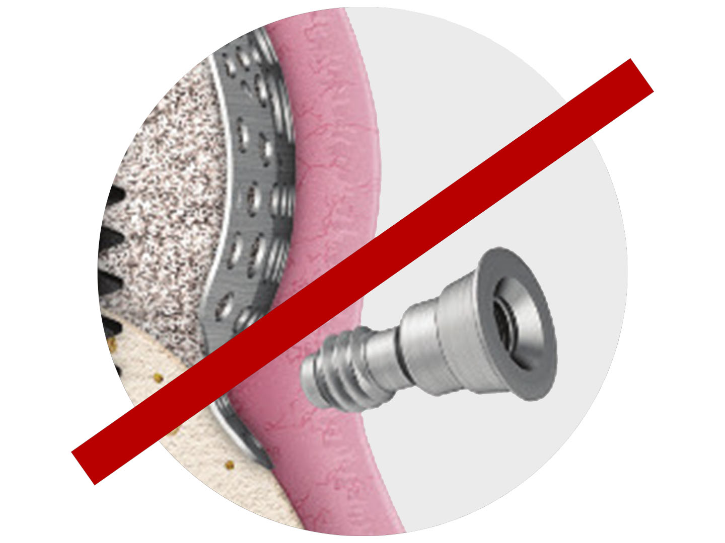 no-fixation-screw-ossbuilder.jpg