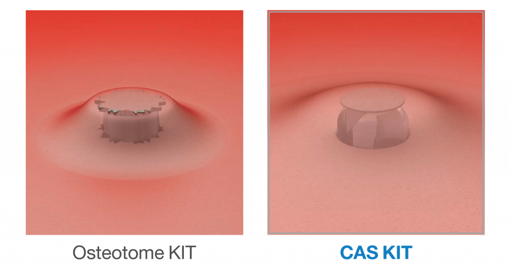 preventing-sinus-membrane-perforation.png