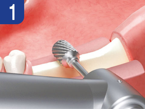 surgical-procedure-step-1-esset-kit.jpg