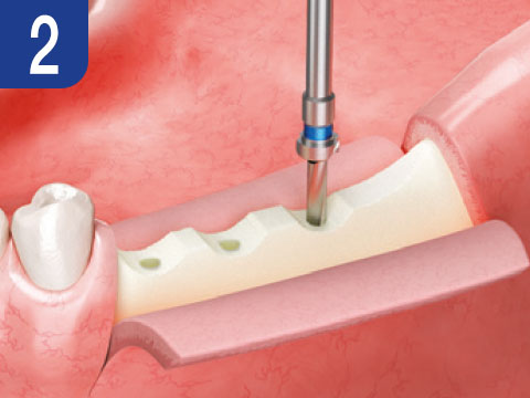 surgical-procedure-step-2-esset-kit.jpg