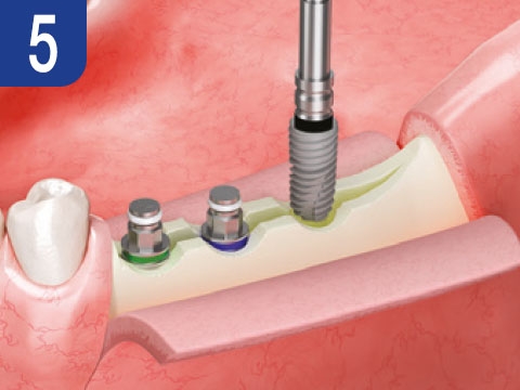 surgical-procedure-step-5-esset-kit.jpg